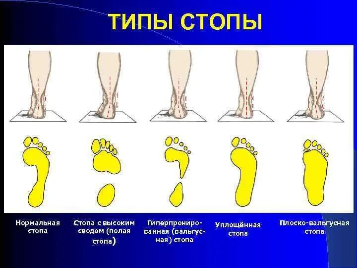 Типы стопы человека. Продольное вальгусное плоскостопие. Продольное плоскостопие косолапость. Плантография вальгусная деформация. Разновидности стопы нормальная уплощенная.