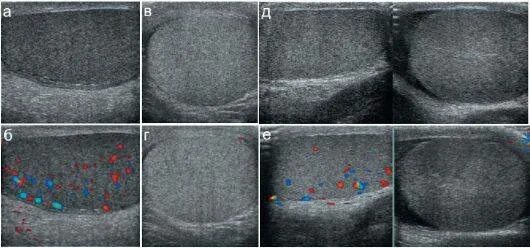 Увеличено яичко у мальчика. УЗИ мошонки крипторхизм. УЗИ яичек при крипторхизме.