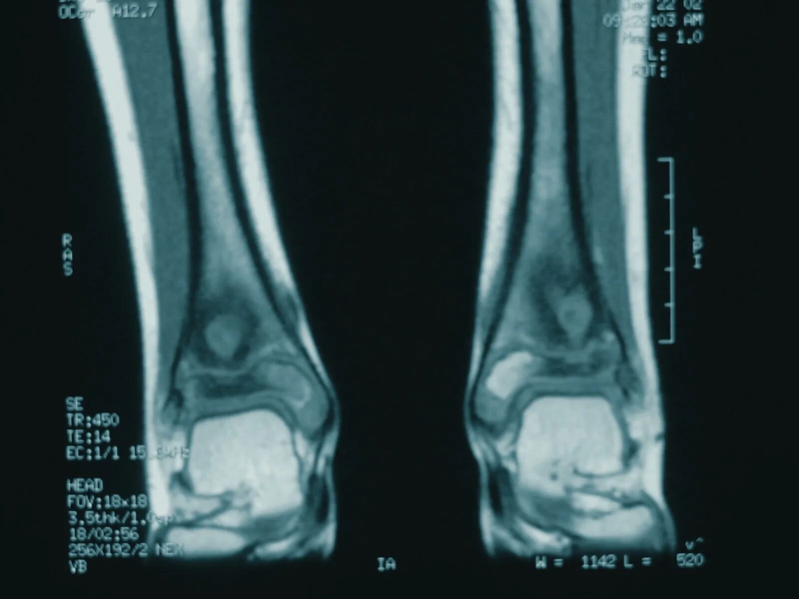 остеомиелит фаланги мизинца. хронический остеомиелит большеберцовой кости кт. остеомиелит трубчатых костей. гематогенный остеомиелит плечевой кости рентген. костяной гарпун мезолит.