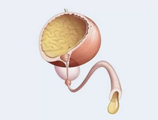 Атоничный мочевой пузырь. Мочевой пузырь и простата. Опорожнение мочевого пузыря. Ощущение неполного опорожнения мочевого пузыря. Неполное опорожнение мочевого у мужчины