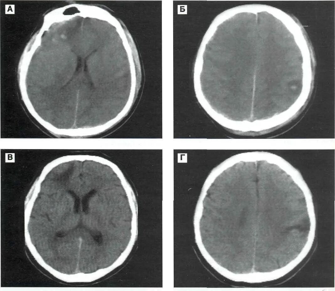 Кистозно-глиозные изменения головного мозга кт. Кистозно глиозные очаги. Глиоз головного мозга кт. Очаги глиоза в головном мозге на кт.