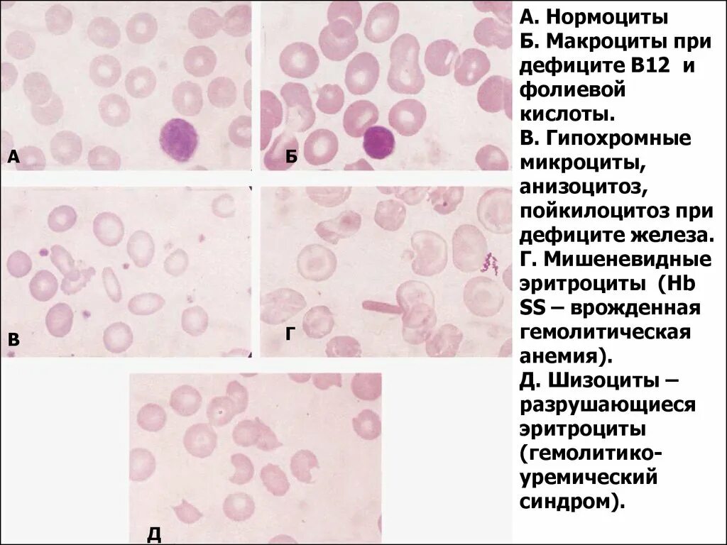 Пойкилоцитоз анемия. Анизоцитоз микроцитоз. Микроцитоз макроцитоз анизоцитоз пойкилоцитоз. Нормоциты и макроциты. Нормоциты микроциты.