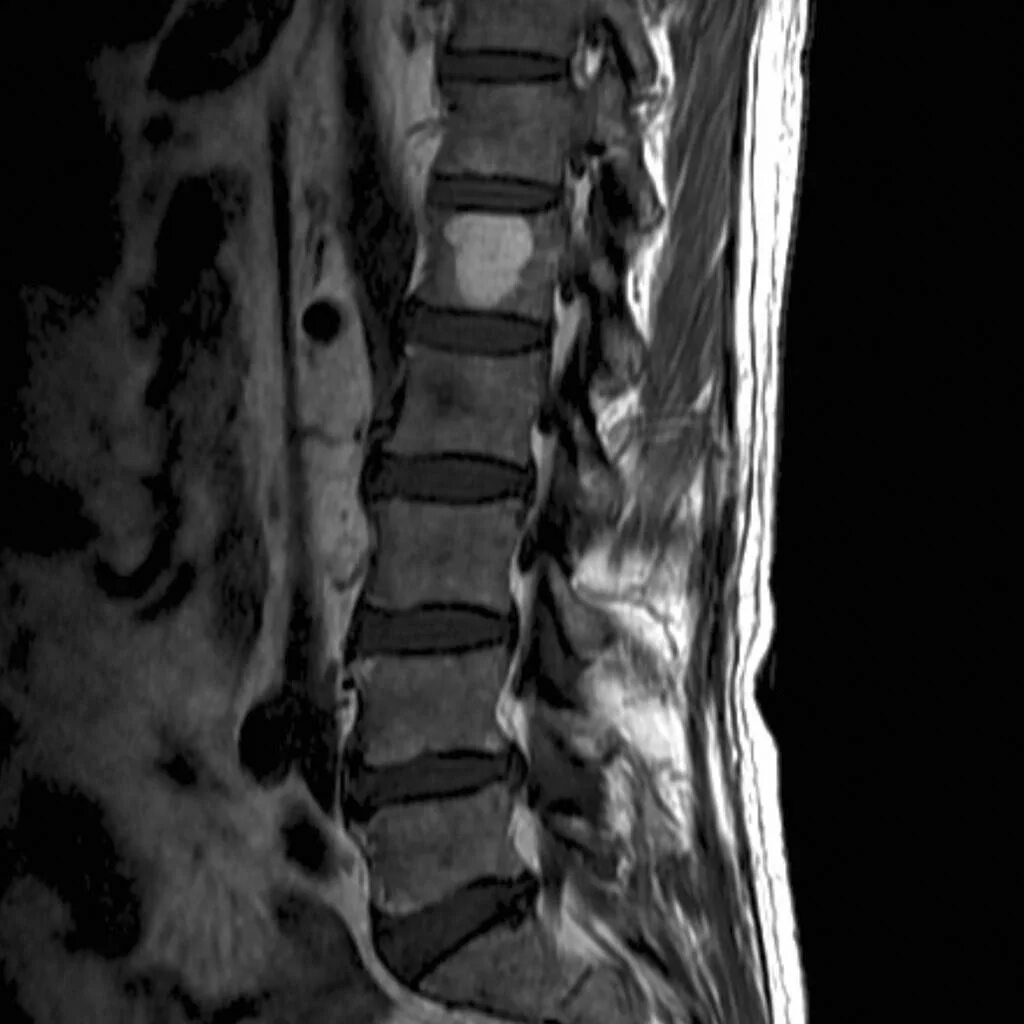 Позвонок th6 гемангиома. Гемангиома th7 позвонка что это. Опухоль в поясничном отделе