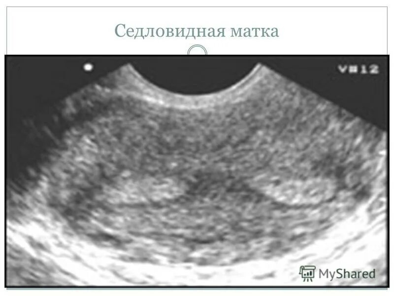 Форма полости матки. Двурогая седловидная матка. Двурогая матка на УЗИ. Матка - седловидная матка.