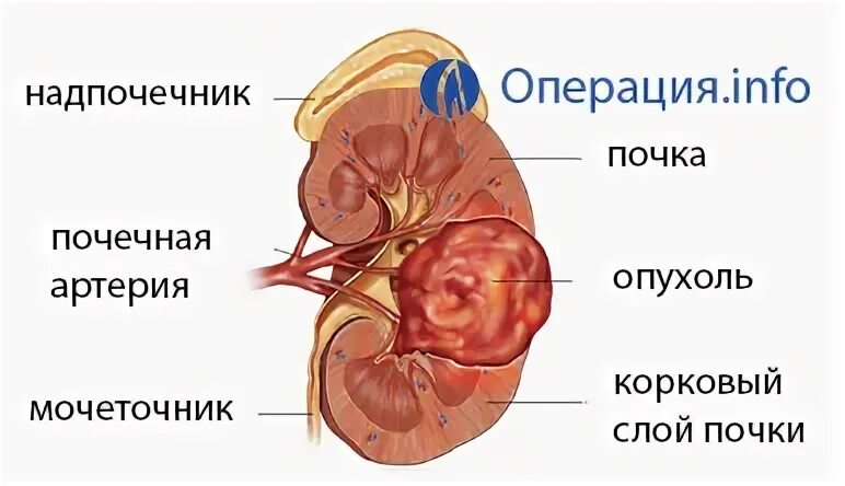 Форум резекции почки. Подготовка к операции резекция почки. резекция опухоли почки.