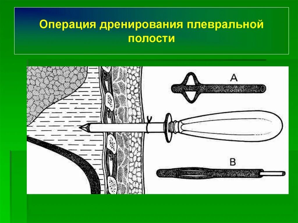 Троакар для дренирования плевральной полости. Троакарный дренаж плевральной полости. Троакар для плевральной пункции. Троакар для пункции плевральной полости.