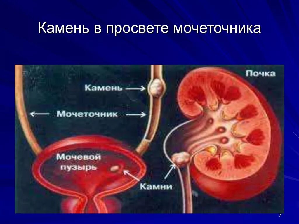 Просвет мочеточника