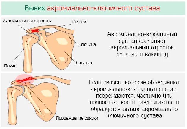 Лечение ключично акромиального артроза. Акромиально-ключичный сустав норма. Акс 2 ст плечевого сустава. Артроз ключично плечевого сочленения. Кости плечевого сустава акромион.