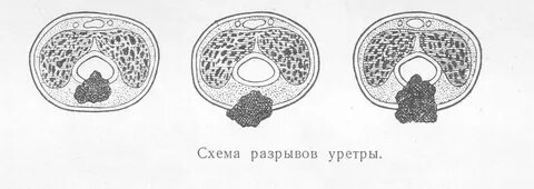 Удаление мочеиспускательного канала