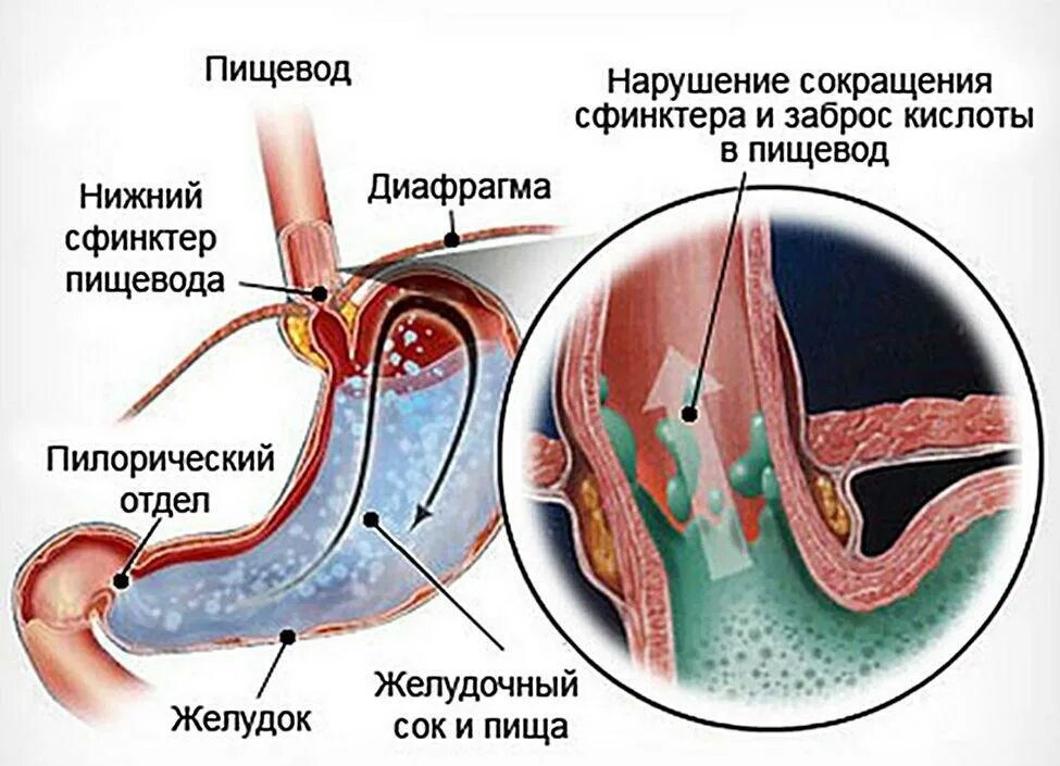 Заброс желчи в горло