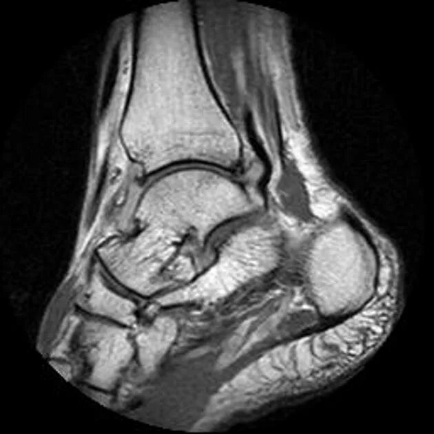 Импиджмент синдром голеностопного сустава мрт. Импинджмент синдром голеностопного сустава рентген. Импинджмент голеностопного сустава мрт. Гигрома голеностопного сустава мрт.
