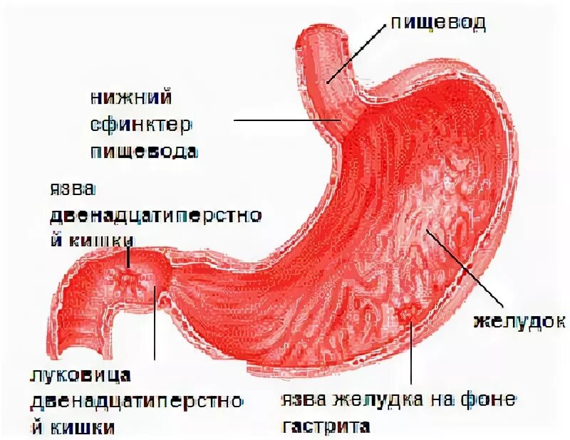 Нижний пищевод. Двенадцатиперстная кишка луковица ДПК. Язвенная болезнь желудка и 12-перстной кишки, воспалительные. Язвенная болезнь луковицы 12 перстной. Язвенная болезнь желудка и 12 перстной кишки.