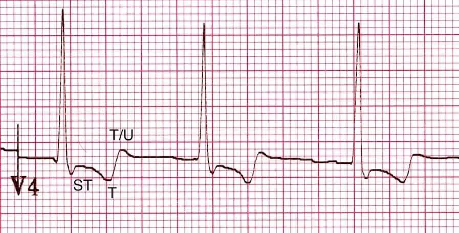 Элевация и депрессия St на ЭКГ. Дигоксин ЭКГ. Депрессия St на ЭКГ v3-v6. Депрессия сегмента St и отрицательный зубец т. Мв на экг