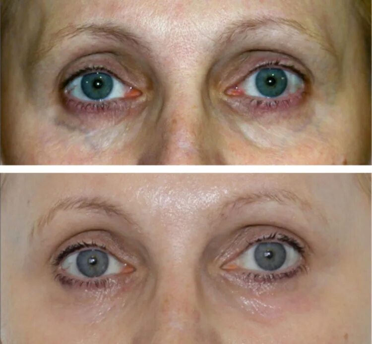 Мезотерапия кожи вокруг глаз. Плазмолифтинг вокруг глаз. Плазмолифтинг вокруг глаз до и после. Плазменная подтяжка