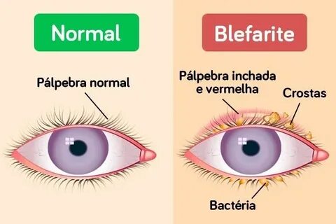 Blepharitis латынь