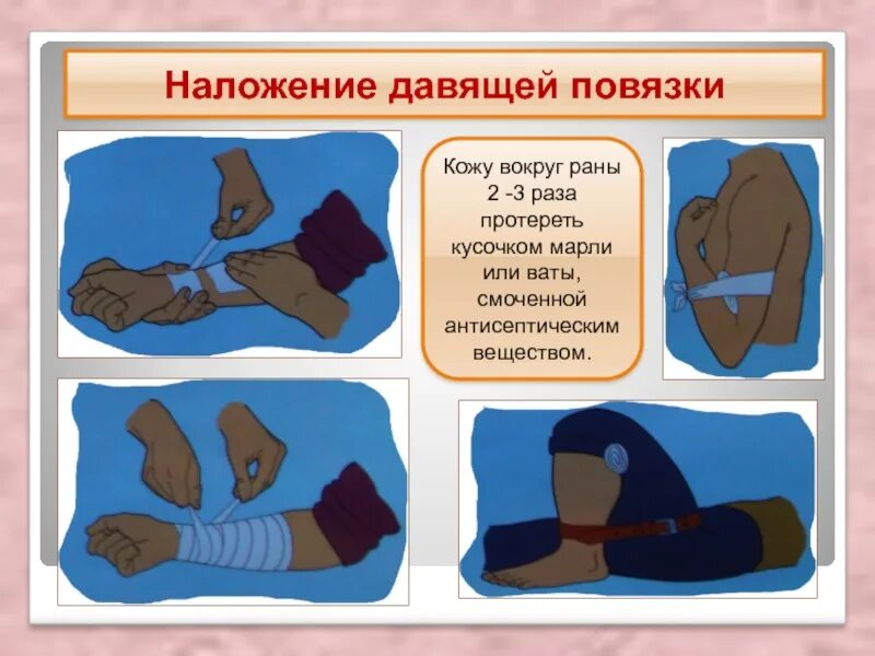 Техника наложения давящей повязки при кровотечении. Наложение давящей повязки. ПМП при массовых поражениях ОБЖ. Презентация на тему первая помощь. Наложение давящей повязки животным.