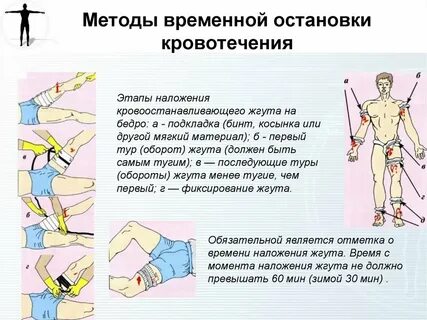 Гемостаз жгут