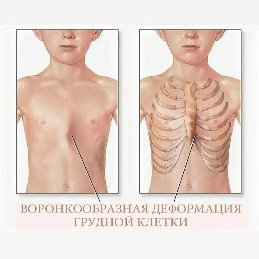 Гипоплазия 12 пары ребер