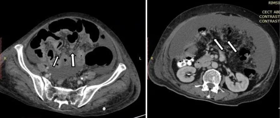 Инфильтрация брыжейки. Мезентериальная жировая клетчатка кт. Инфильтрация брыжейки. Перитонеальный карциноматоз на кт. Инфильтрация брыжейки.