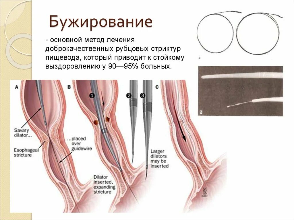 Сужение мочеиспускательного канала. Бужирование пищевода что это техника проведения. Бужирование пищевода методика. Стеноз пищевода бужирование. Эндоскопическое бужирование пищевода техника операции.