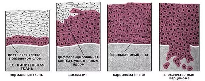 Дисплазия клеток это. Дисплазия клеток это. Степени дисплазии клетки. Дисплазия клеток это. Дисплазия шейки матки микропрепарат.