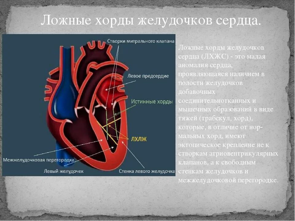 Наличие хорды у человека. Хорда в правом желудочке сердца у плода. ЭХОКГ ложная хорда. Аномалия хорда левого желудочка поперечная. Дополнительная хорда митрального клапана.