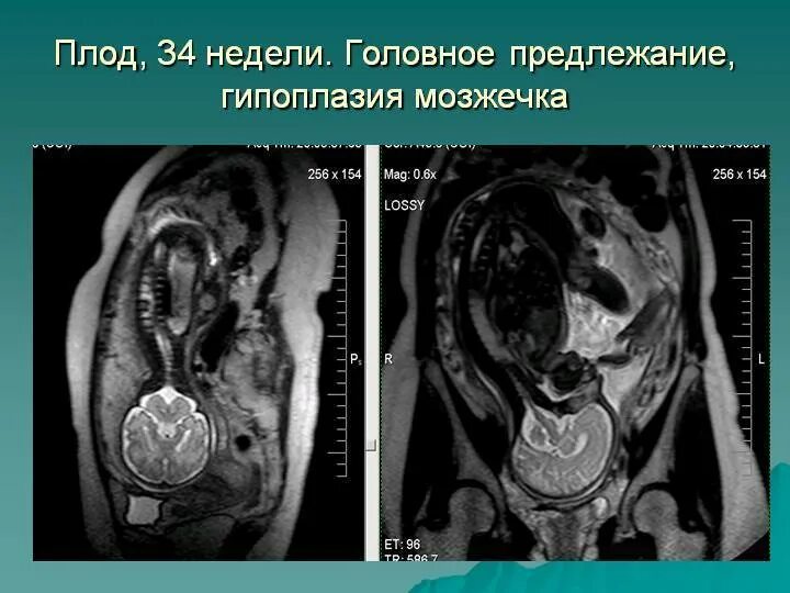 Гипоплазия червя. Брюшная беременность мрт.