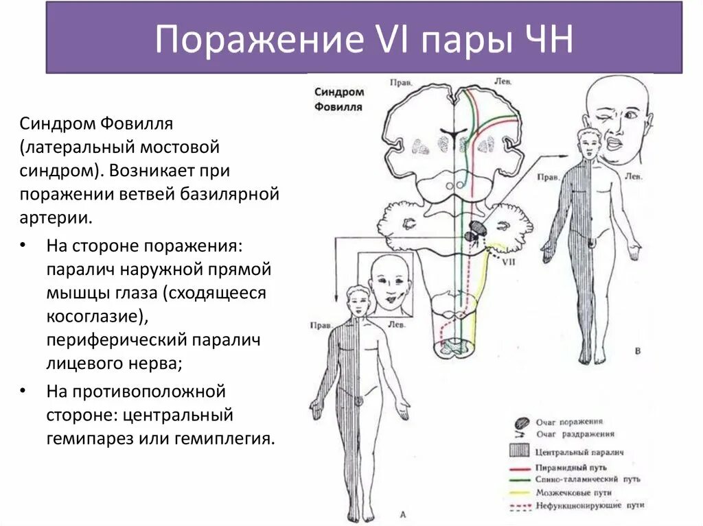 Очаг поражения и симптомы при синдроме Фовилля. Альтернирующий гемипарез. Альтернирующий синдром Фовилля. Альтернирующий синдром Вебера. Лев гемипарез