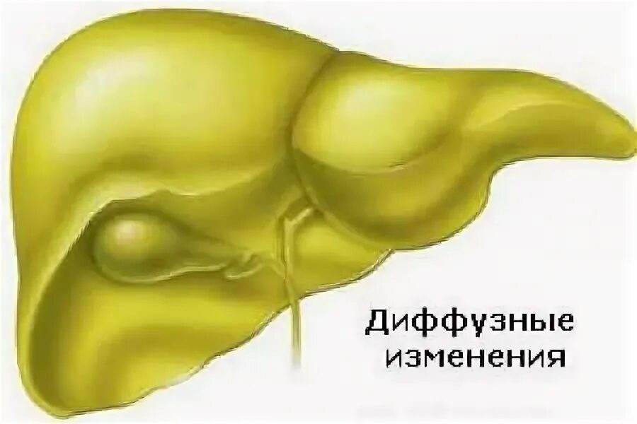 Диф изменения печени. Диффузные изменения печени. изменение паренхимы печени. диффузные изменения паренхимы печени. д ифузные изменения печени.