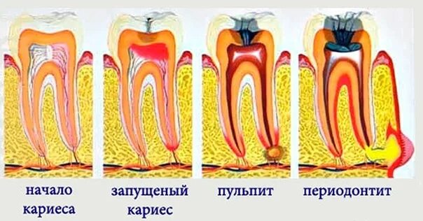 Как снять боль от пульпита быстро Лечение пульпита, цена в Москве.