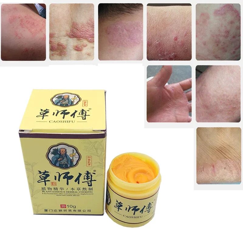 Мазь от экземы на руках цена. Китайская мазь от псориаза. Eczema Cream. Китайская мазь от псориаза дерматита экземы. Лекарство от псориаза на ногах и руках.