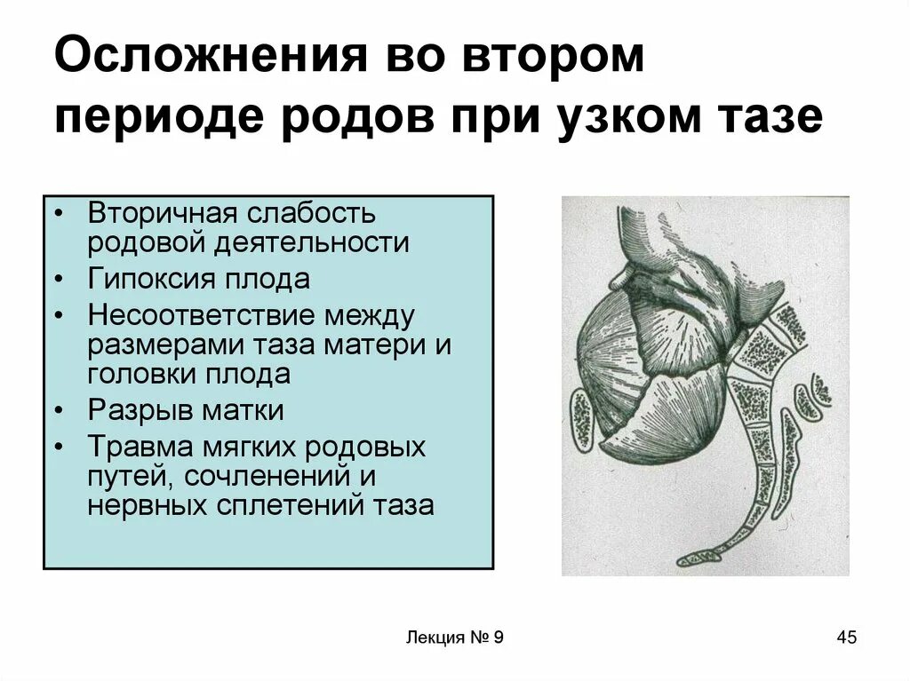 Роды при осложненной беременности. Осложнения 2 периода родов. Осложнения во 2 периоде родов при узком тазе. Осложнения беременности и родов при узком тазе. Осложнения в первом периоде родов при узком тазе.