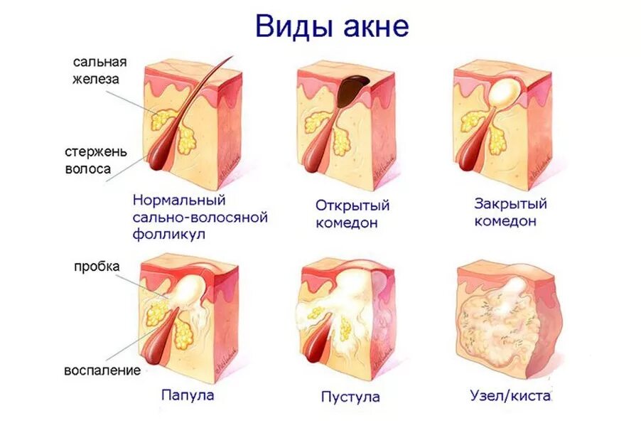 Что сделать чтобы прыщ быстрее прошел. Что сделать чтобы прыщ быстрее прошел