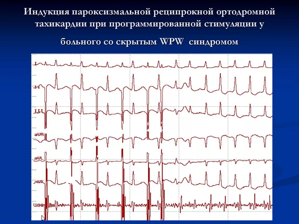 Тахикардия при всд. Экг при синдроме ортодромная тахикардия при wpw. синдром впв ортодромная тахикардия. наджелудочковая тахикардия при wpw. наджелудочковая тахикардия при синдроме wpw.