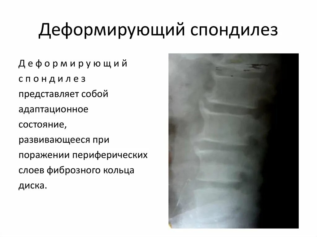 Деформирующий спондилез спондилоартроз. Деформирующий спондилез спондилоартроз