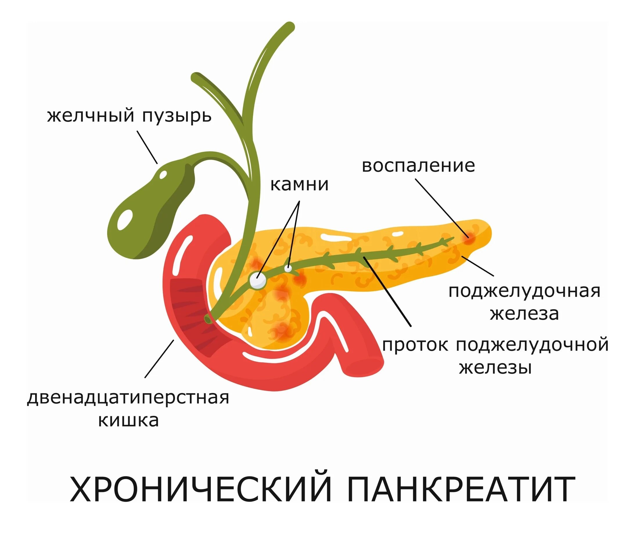 Хроническое заболевание поджелудочной. Хроническое воспаление поджелудочной железы. Болезнь хронический панкреатит поджелудочной железы. Что такое панкреатит поджелудочной. Панкреатит поджелудочной железы при обострении.