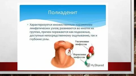 Поражение лимфатических узлов