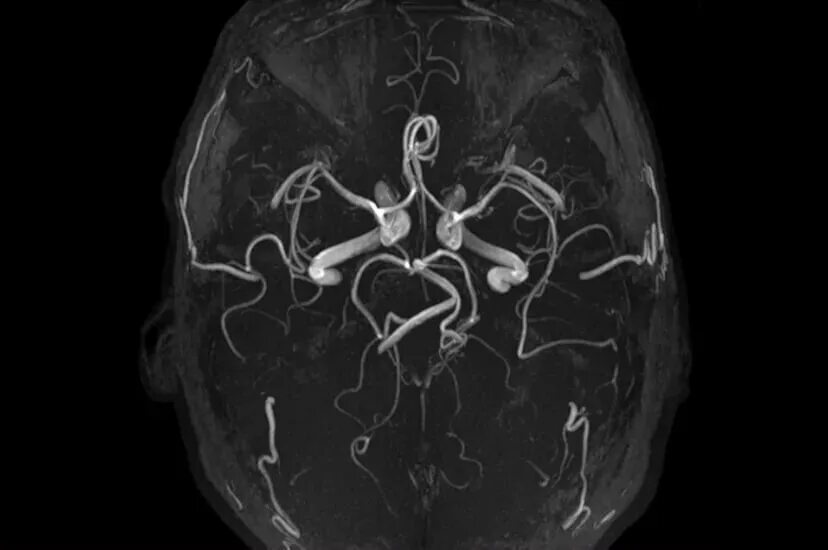 Венография головного мозга. Магнитно-резонансная ангиография артерий головного мозга. Кт ангиография головного мозга. СКТ-ангиография сосудов головного мозга. Кт ангиография сосудов головного мозга.