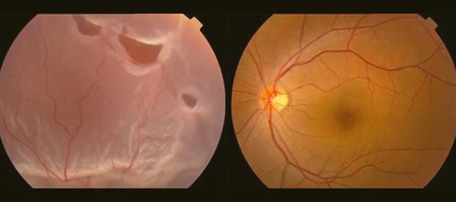 Эпиретинальный фиброз глаза. Ретиношизис сетчатки глазное дно. Ретиношизис Тотальный. Пузыревидный ретиношизис. Ретиношизис макулы окт.