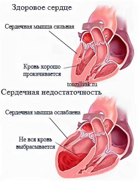 Осложнение на сердце после. Ревматизм поражение сердца. Осложнения на сердце после ангины.