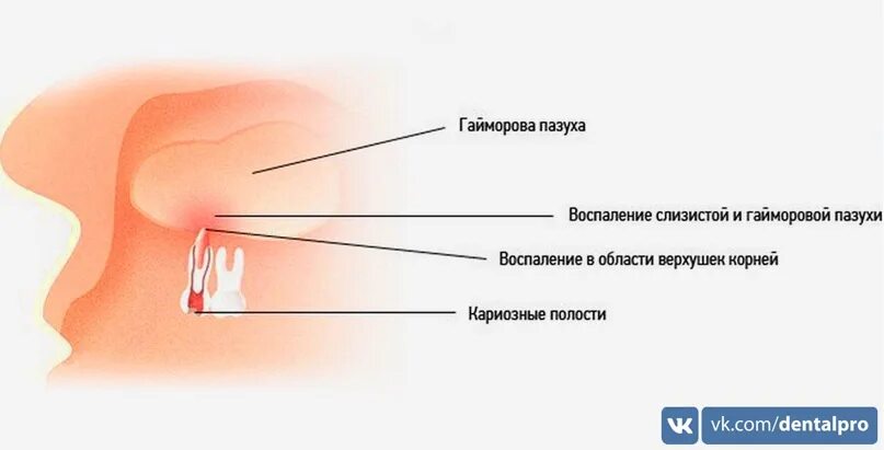 Как отличить зубную боль от воспаления. Воспаление верхнечелюстной (гайморовой) пазухи. Воспалились пазухи зуба.