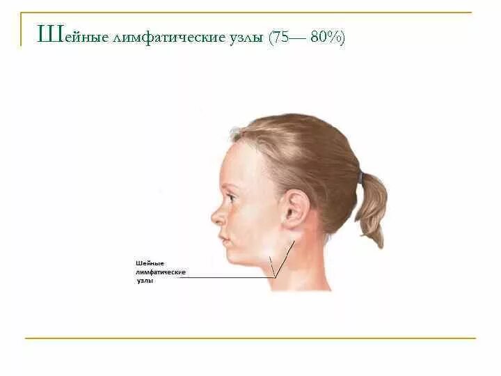 Лимфоузлы 3 месяца. Туберкулез периферических лимфатических узлов. Туберкулез шейных лимфатических узлов. Формы поражения туберкулезом периферических лимфатических узлов. Увеличение периферических лимфатических узлов.