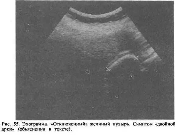 Сгустки в желчном пузыре. УЗИ картина отключенного желчного пузыря. Выключенный желчный пузырь УЗИ. Склерозированный желчный пузырь на УЗИ. Нефункционирующий желчный пузырь на УЗИ.