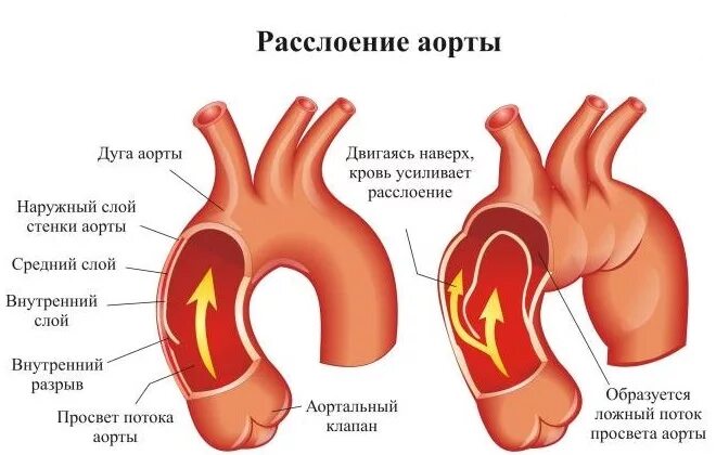 Почему в аорте