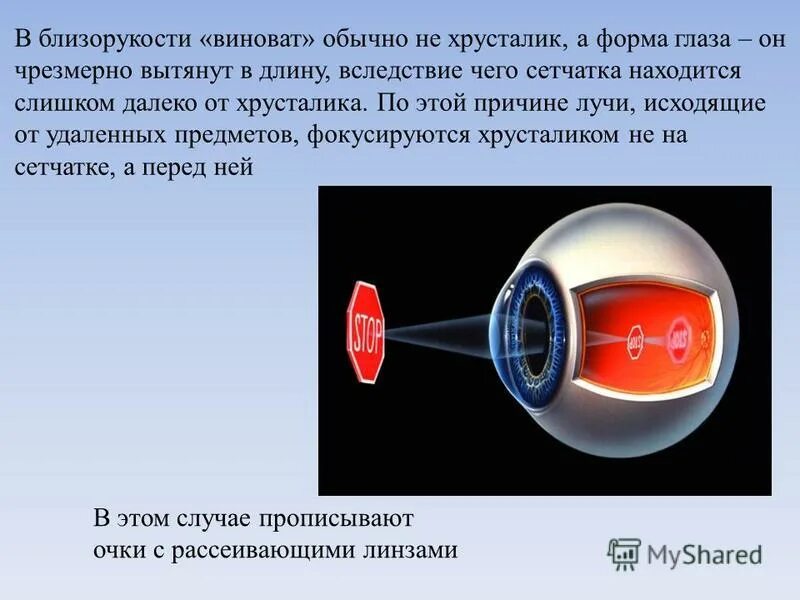 при близорукости лучи света фокусируются за сетчаткой