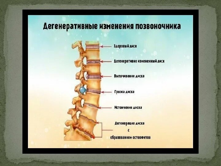 Дистрофические изменения позвоночника. Дегенеративно деструктивные заболевания позвоночника. Дегенеративно дистрофические изменения грудного отд позвоночника. Генеративное изменение позвоночника. Дистрофические изменения шейного позвоночника.