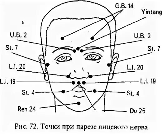 Иглоукалывание лицевой нерв. Неврит лицевого нерва точечный массаж. Точки воздействия при неврите лицевого нерва. Акупунктурные точки при неврите лицевого нерва. Точки акупунктуры при парезе лицевого нерва.