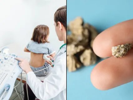 Kidney stones are rising among children and teens; learn possible causes and how