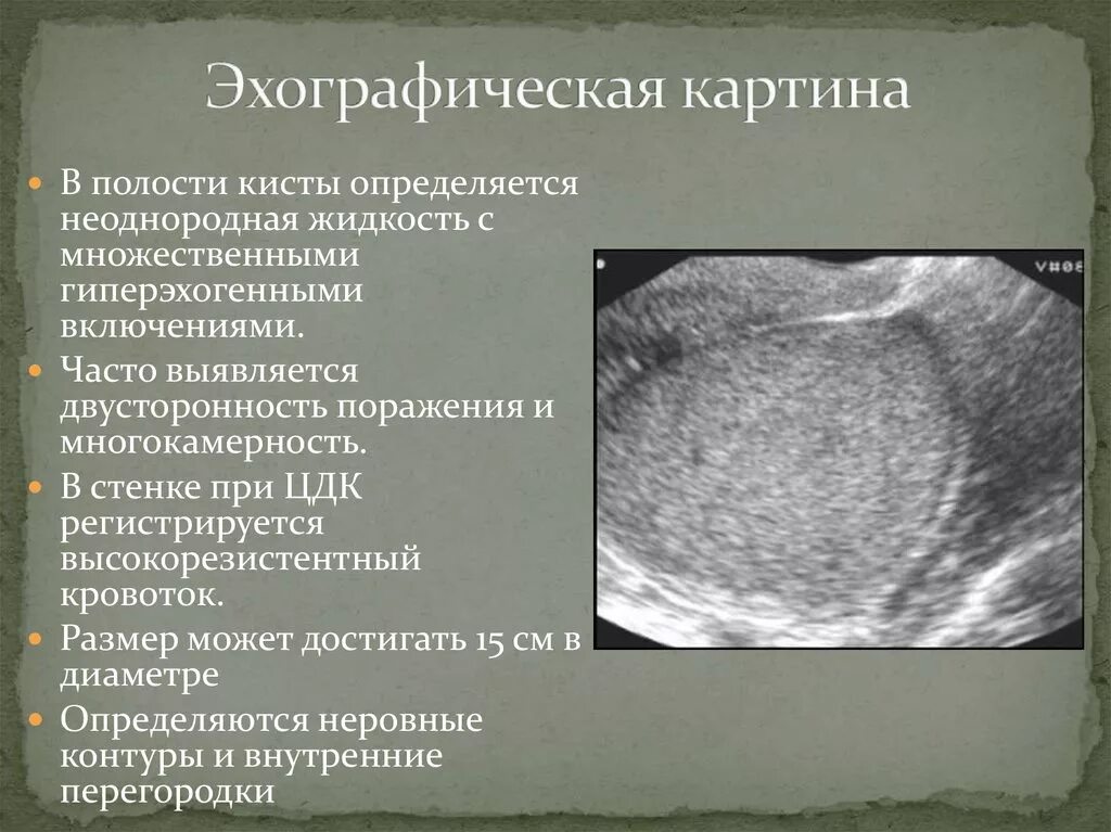 Полость матки 10. УЗИ при хроническом эндометрите. Множественные гиперэхогенные включения в матке. Образование в полости матки. Хронический эндометрит УЗИ картина.