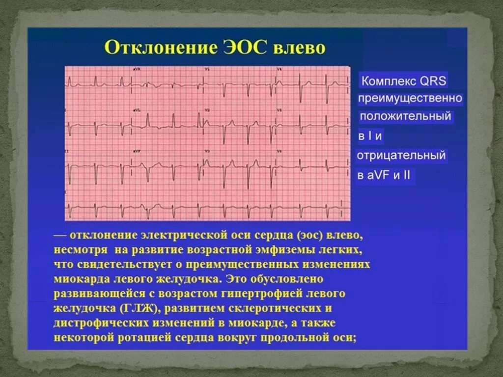 Отклонение параметров QRS. Отклонение параметров QRS на ЭКГ. Кардиограмма с отклонениями. Что такое отклонение параметров QRS В кардиограмме.